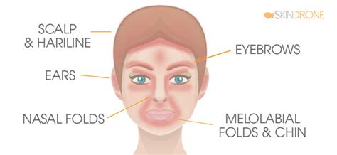 Illustration showing the common areas affected by seborrheic dermatitis on the face and scalp.