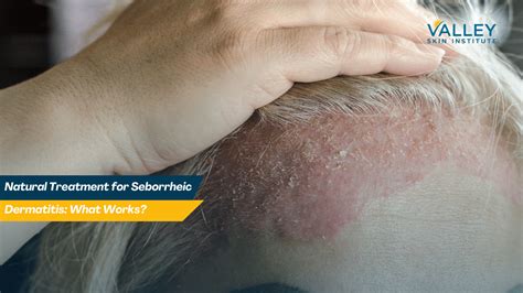 Infographic comparing conventional and homeopathic treatment approaches for seborrheic dermatitis.