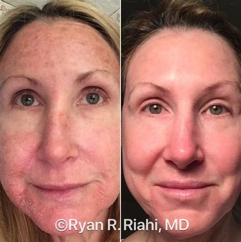 Collage of images showing before-and-after results of common professional treatments for sun damage.