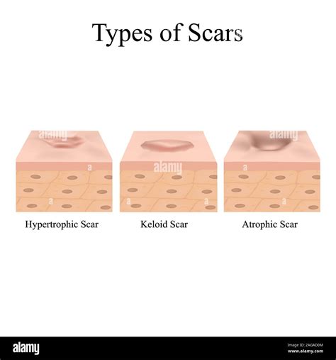 Illustration showing the three main types of acne scars: atrophic, hypertrophic, and keloid.