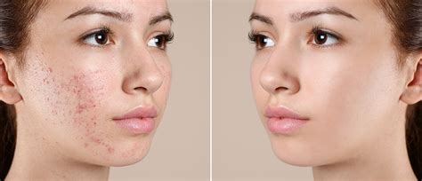split image showing a close-up of skin with acne before and after treatment with a sulfur-based product