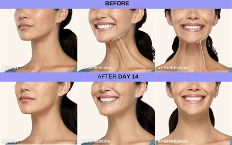 Collage of before and after photos showing the reduction of neck bands after Botox treatment.