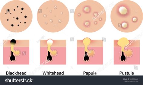 An infographic illustrating the different types of pimples: whitehead, blackhead, papule, pustule, nodule, cyst.