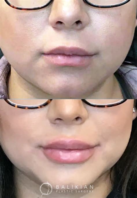 Illustration of lips before and after augmentation, showing increased volume and improved symmetry.