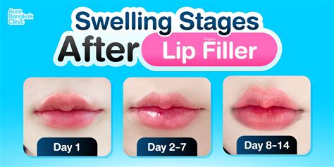 Diagram illustrating the typical timeline of swelling and bruising after lip filler injections.
