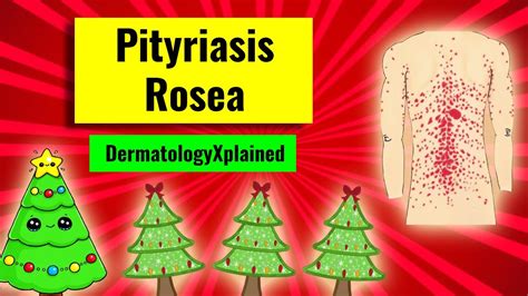 Illustration of pityriasis rosea rash pattern on the back, resembling a Christmas tree.