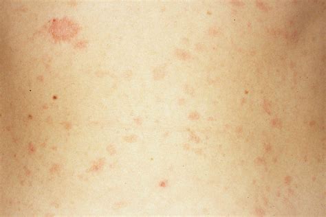 Close-up image of pityriasis rosea rash showing characteristic scaly, oval patches.