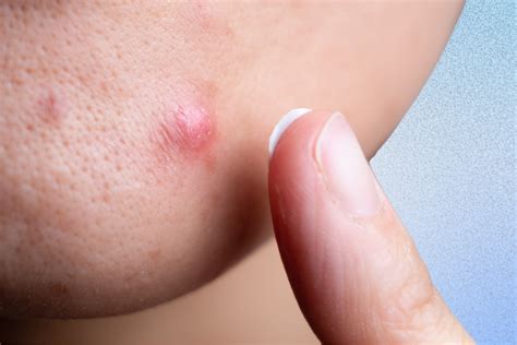 Close-up photo demonstrating the application of concealer on a cystic pimple.