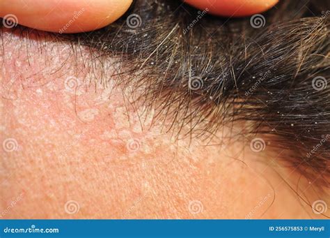 Close-up of a dog's skin showing scales and redness, indicative of seborrhea