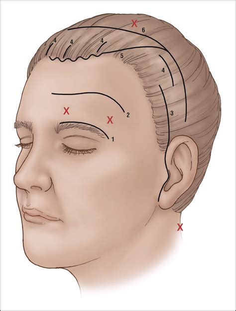 Diagram illustrating the placement of incisions for different brow lift techniques.