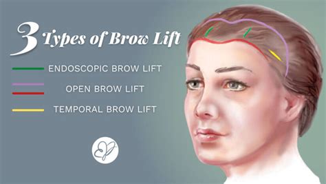 Illustration comparing the visual results of different brow lift techniques.