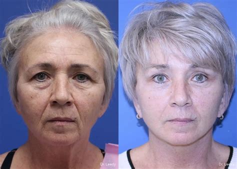 Before and after photos of a patient who underwent a brow lift procedure.