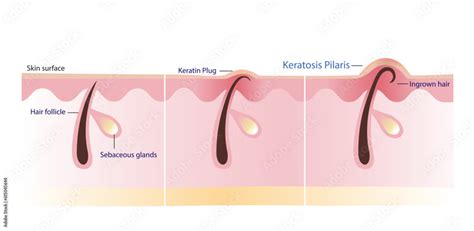 Infographic illustrating the process of gentle exfoliation for keratosis pilaris.