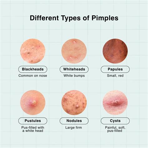 Diagram illustrating common causes of forehead bumps, including pimples, cysts, lipomas, and osteomas.
