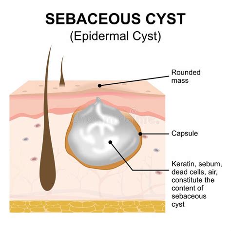 Cross-section illustration of a skin cyst, showing its formation from trapped skin cells and keratin.