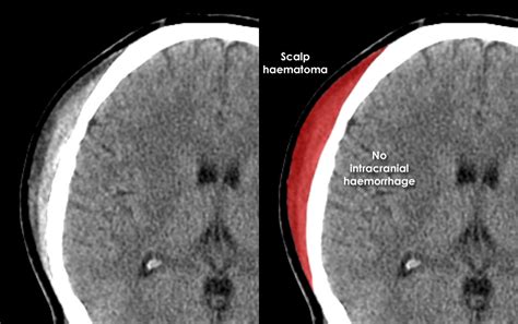 Illustration of a scalp hematoma, showing pooled blood beneath the skin after head trauma.