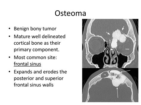 Diagram showing an osteoma as a bony growth on the skull.