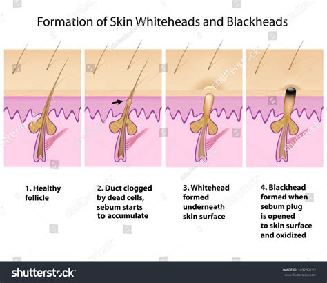 Diagram illustrating the formation of a whitehead and a blackhead within a hair follicle.