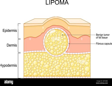 Illustration showing cross-section of skin with different types of benign lumps like cysts, lipomas, and fibromas.