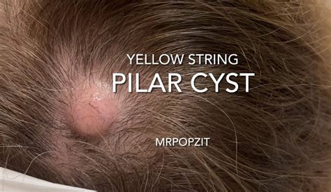Close-up image of a pilar cyst on a scalp.