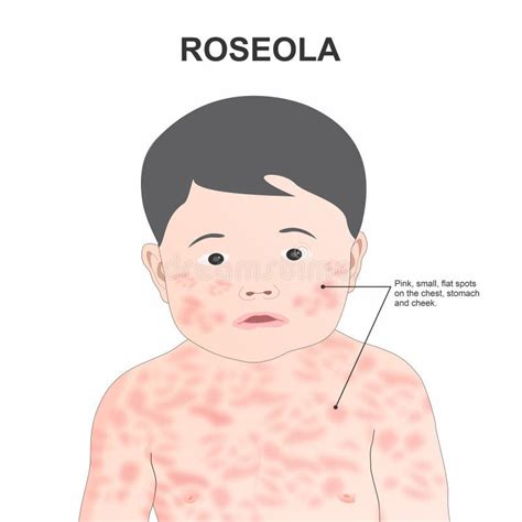 Close-up image of a roseola rash on a child's skin.