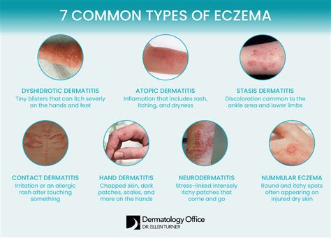 Illustration showing the scrotum with common eczema symptoms like redness and dryness.