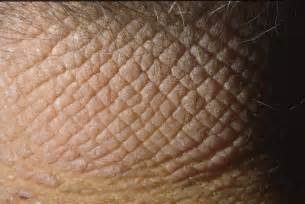 Close-up image showing the texture of lichenified skin on the scrotum.