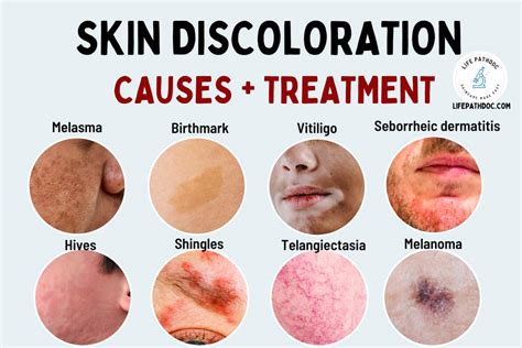 Visual representation of potential side effects on the skin, such as thinning and discoloration.