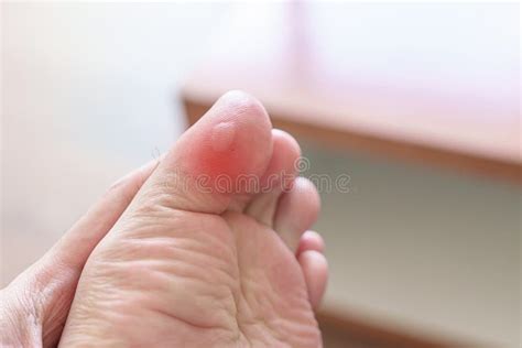 Man holding toe with blister