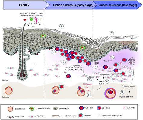Infographic illustrating the cellular changes associated with untreated lichen sclerosus leading to potential cancer development.