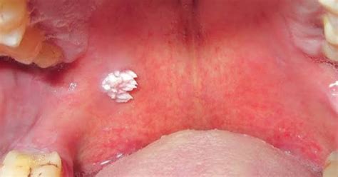 Close-up image showing the appearance of an oral papilloma on the tongue