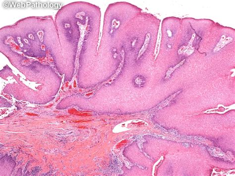Microscopic view of oral squamous cell papilloma cells during histopathological examination