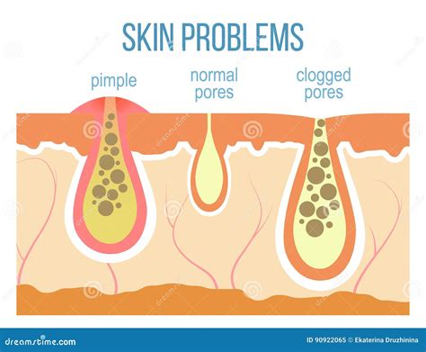 Close-up illustration of skin pores clogged by mineral deposits.