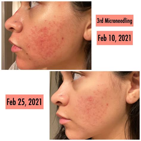 infographic illustrating the mechanism of action of sulfacetamide and sulfur on skin