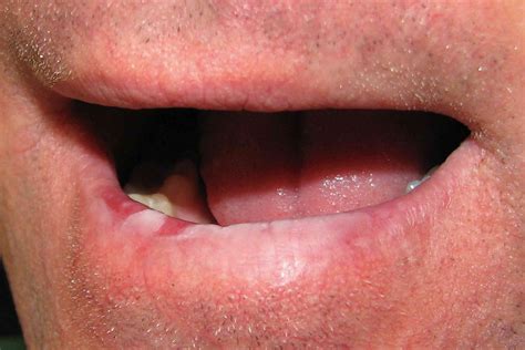 Image showing symptoms of actinic cheilitis