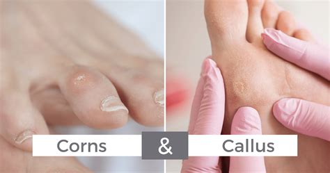 Collage of images showing different types of hyperkeratosis: calluses, corns, and potentially a more severe case with cracking.