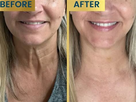 Before and after images of Botox treatment for platysmal bands