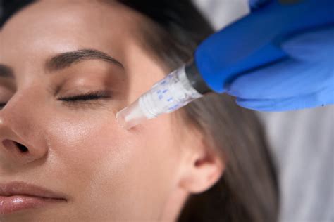 Close-up image of skin undergoing microneedling treatment.