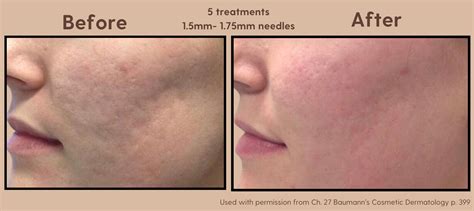 Before and after photos of microneedling results, showing improved skin texture and reduced scarring