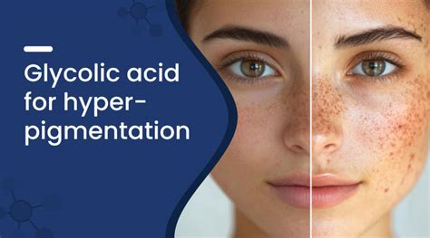 Illustration showing the effect of glycolic acid on hyperpigmentation