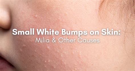 Infographic illustrating milia as small white bumps on the skin, distinguishing them from acne.