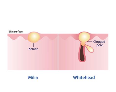 Diagram showing a cross-section of skin with a milia cyst formed by trapped keratin.