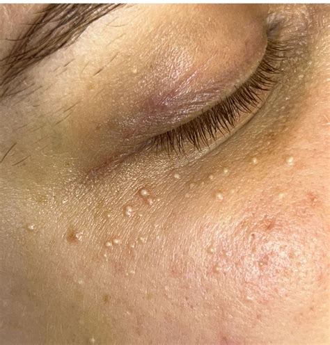 Image comparing milia, whiteheads, and pimples for clarity.