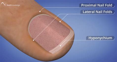 Illustration showing the anatomy of a fingernail and surrounding nail folds, highlighting the proximal and lateral nail folds where paronychia occurs.
