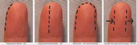 Illustration showing recommended incision sites for felon drainage (lateral longitudinal and high midline) and sites to avoid (transverse).
