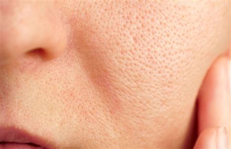 Close-up image showing enlarged pores and then reduced pore appearance after retinol treatment
