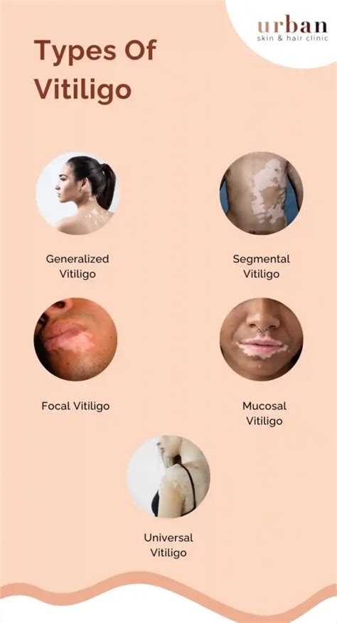 Image showcasing different stages and locations of vitiligo on the skin.