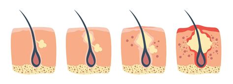 Illustration showing a clogged hair follicle with bacteria growth, leading to a pimple.