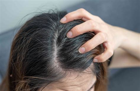 Close-up image of a person scratching an itchy scalp.