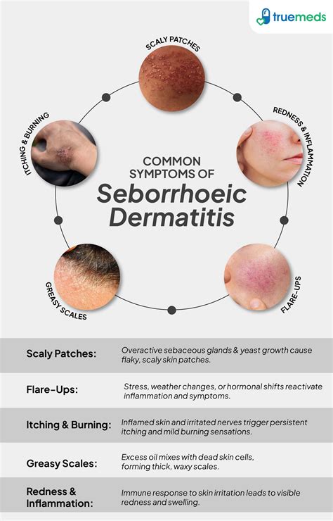 Diagram illustrating the distribution of seborrhoeic dermatitis on the scalp and face.